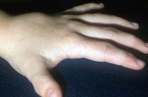 Die Hand eines sechsjährigen Mädchens, das an Rheuma leidet. Die Gelenke sind entzündet, geschwollen und schmerzen bei Bewegung. Foto: Girschick