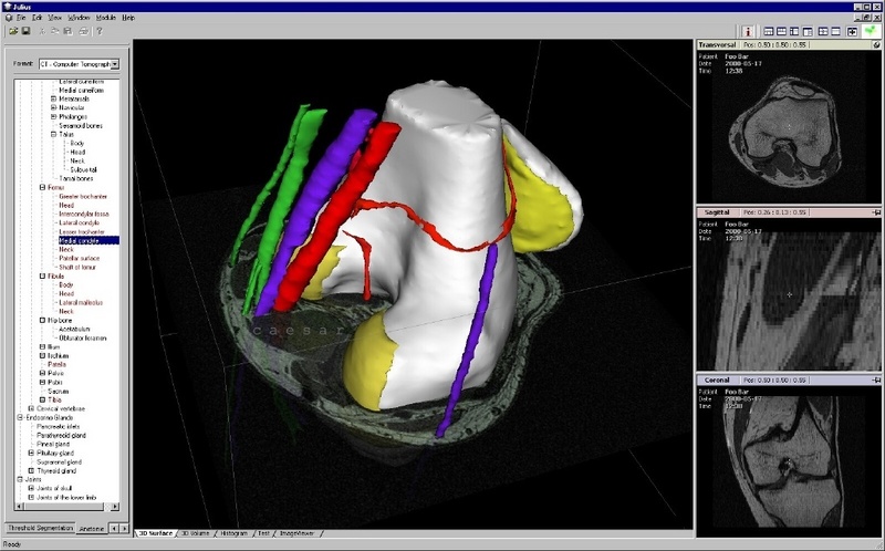 Mit Julius erstelltes dreidimensionales Kniegelenk, rechts die dazugehörigen fusionierten CT- und MR-Aufnahmen des Patienten. Grafik: caesar