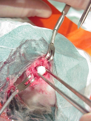Noch im klinischen Versuch: Ein neuartiges Implantat für den Aufbau solider Knorpel- und Knochenmasse im Körper.