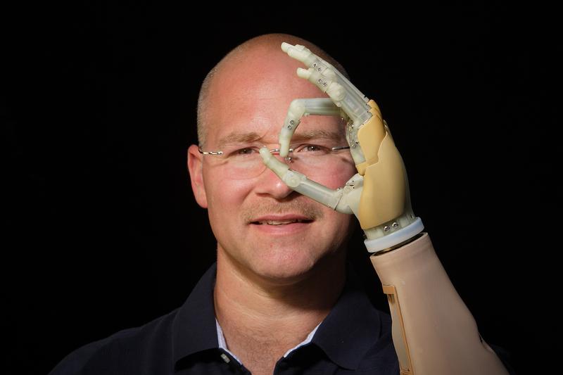 Erste bionische Handprothese mit fünf individuell angetriebenen Fingern