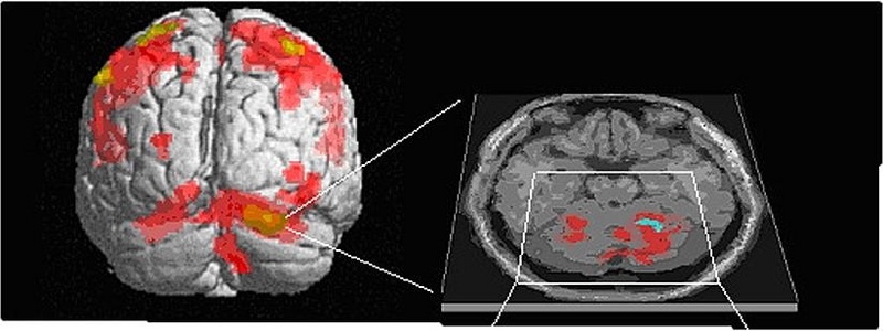 fMRT-Aufnahme des Gehirns. Die rot gefärbten Felder zeigen an, welche Hirnareale aktiviert werden, wenn ein Proband seine Finger bewegt. (Aufnahme: Klinik für Neurologie, Lübeck)