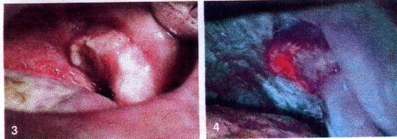 Unter blauem Licht (Bild rechts) leuchtet der Tumor rot; links die Mundhöhle desselben Patienten unter Weißlicht.