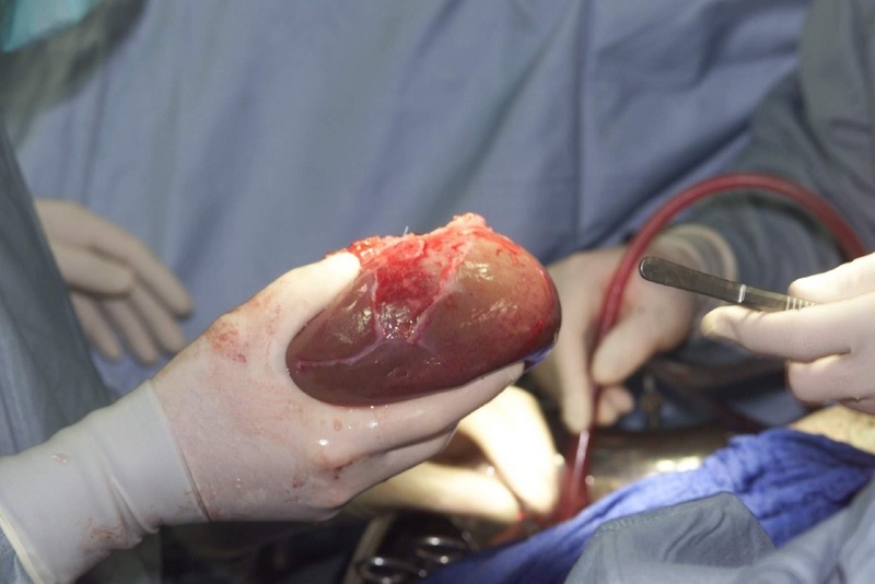 Bei der Leberlebendspende wird ein Leberlappen entfernt und transplantiert / Foto: Chirurgisches Universitätsklinikum Heidelberg