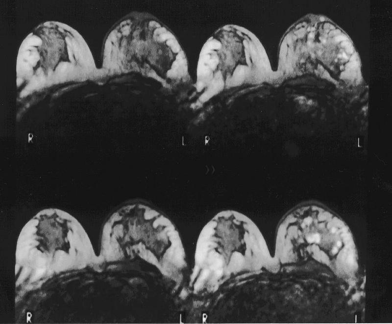Das wohl sicherste Verfahren in der Brustkrebsdiagnostik ist die Magnetresonanz-Mammographie. Das Bild zeigt eine Patientin links vor und rechts nach der Kontrastmittelgabe. In der linken Brust waren 33 kleine Krebsherde (weiße Bezirke).