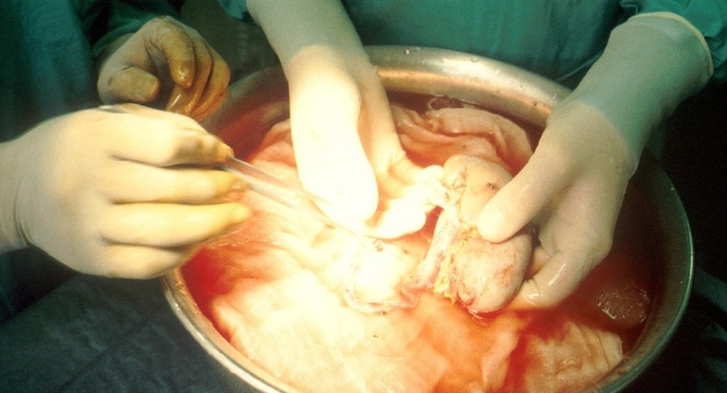 Vor der Transplantation wird die Niere in Eiswasser gelegt, gesäubert und gespült. Neue Lübecker Ergebnisse versprechen bessere Langzeiterfolge