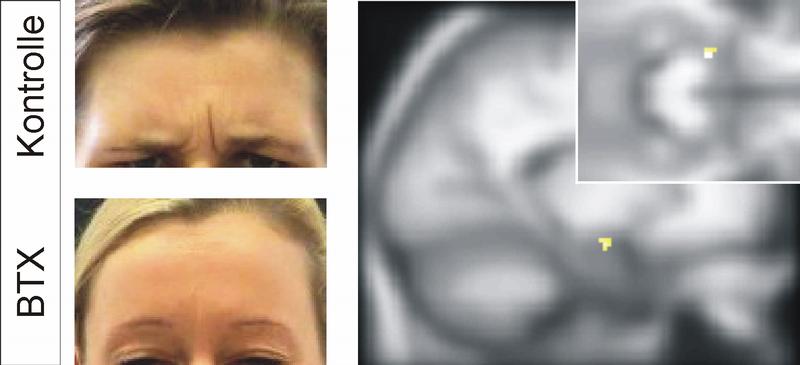 Die Abbilung zeigt die deutlich geringer ausgeprägte Mimik bei der Ausführung eines wütenden Gesichtsausdruckes im Falle von mit Botulinumtoxin (BTX) behandelten "Zornesfalten". Die rechte Abbildung zeigt in Gelb die Abnahme der Gehirnaktivität im Bereich der linken Amygdala infolge der dadurch bewirkten Abmilderung des sensorischen Feedbacks.