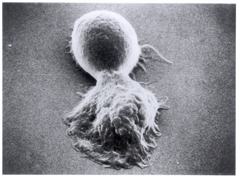 Angriff eines aktivierten Makrophagen - Teil unseres Immunsystems - auf eine Krebszelle; elektronenmikroskopische Aufnahme. (Foto: Ringsdorf)