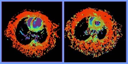 Diese NMR-Bilder zeigen Querschnitte durch den Brustkorb einer gesunden Ratte (rechts) und einer Ratte, die zuvor einen Herzinfarkt erlitten hat. Bei letzterer ist die Narbe als Ausdünnung in der Vorderwand des Herzens zu erkennen.  Bilder: Waller