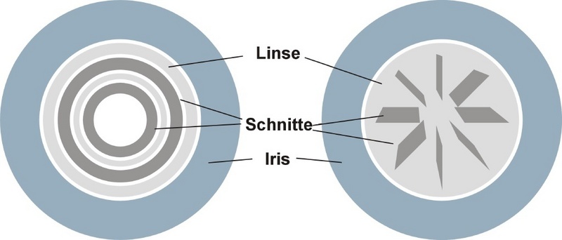 Behandlung von Presbyopie durch Schnittmuster in Augenlinsen (schematisch). Links: ringförmig. Rechts: Sternförmig