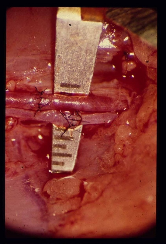 Chirurgen verbinden heute Blutgefäße, die einen Millimeter durchmessen.