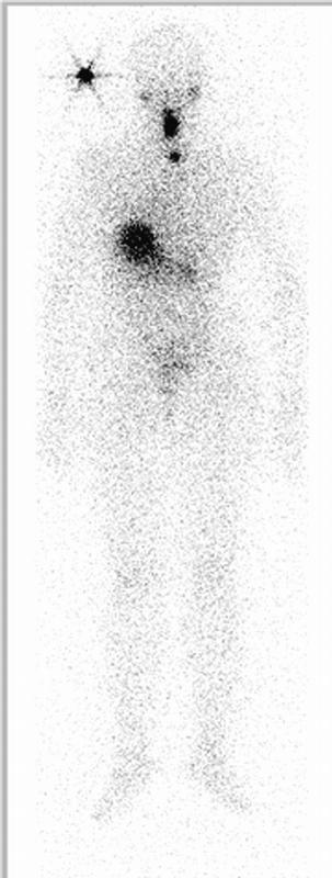 Bildgebung nach Gabe von radioaktivem Jod: Aufnahme in Schilddrüsenrest und Lymphknoten