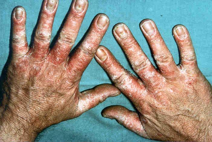 Mit Psoriasis palmaris befallende Hände vor der Therapie.