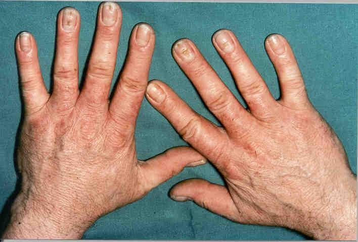 Mit Psoriasis palmaris befallene Hände nach der Therapie.