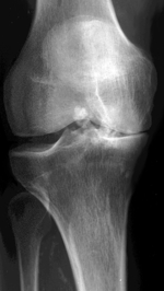 Röntgenbild einer fortgeschrittenen Arthrose des Kniegelenkes mit verlorengegangenem Gelenkspalt auf der rechten Seite.