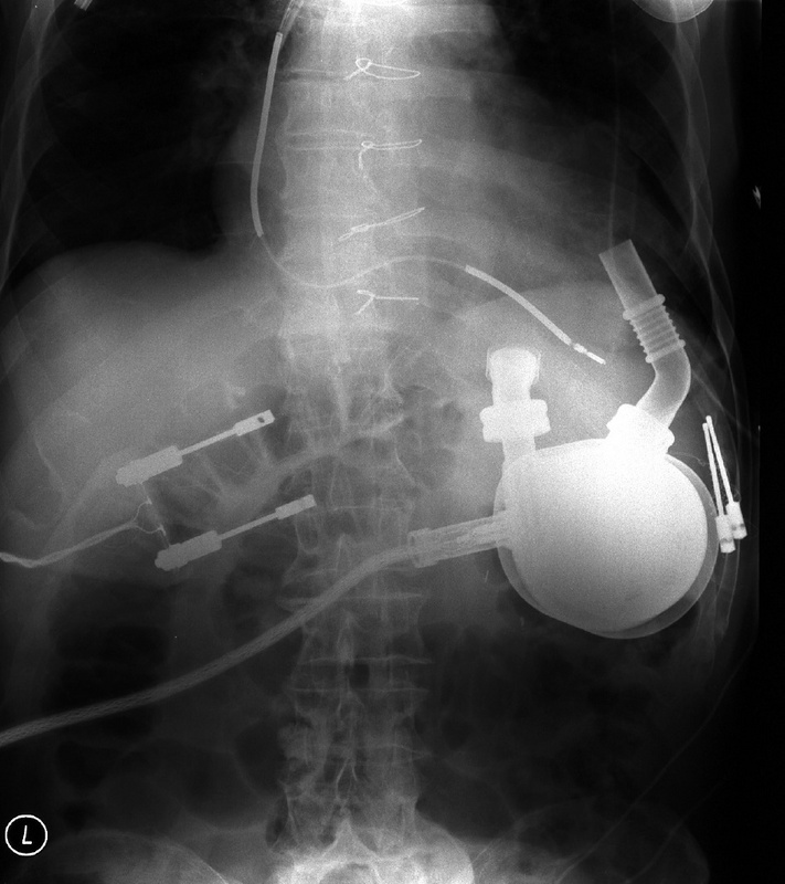 Röntgenbild: Die Lage der DuraHeart-Pumpe im Brustkorb