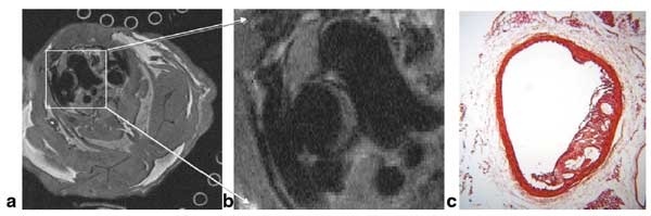 Arteriosklerotische Plaques, mit Magnetresonanz (MR) sichtbar gemacht (a, b), im Vergleich mit dem entsprechenden Gewebeschnitt (c): Aussehen und Größe der Ablagerungen stimmen stark überein. Die Aussagekraft der Bilder ist sehr hoch. Bild: Wiesmann