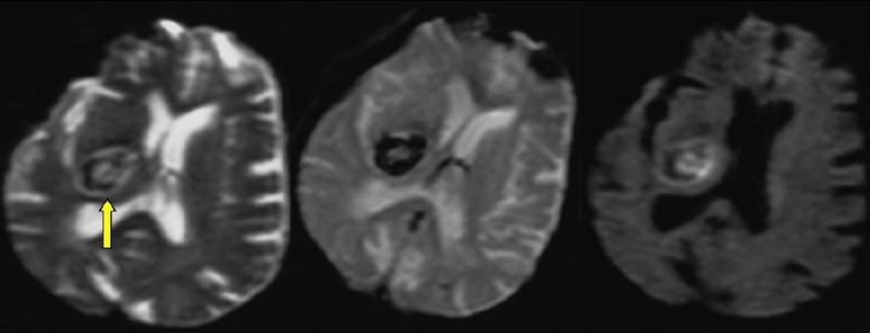 In drei verschiedenen MRT-Bildern war eine Hirnblutung deutlich zu erkennen. / Abb.: Universitätsklinikum Heidelberg.