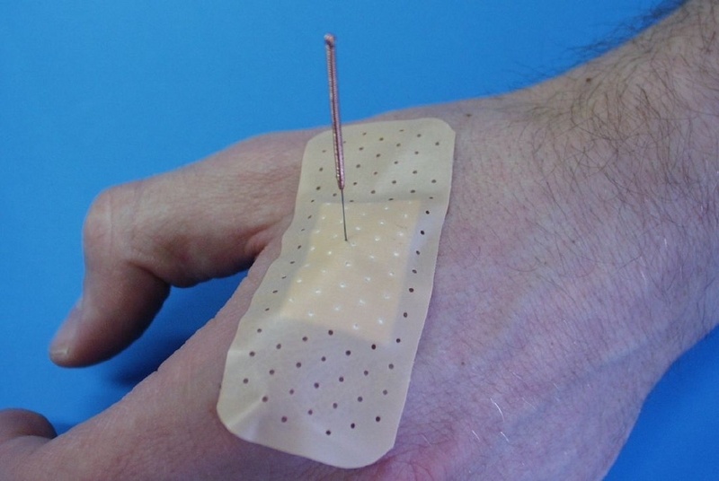 Mit der Placebo-Nadel kann ein Akupunkturstich simuliert werden, ohne die Haut zu verletzen. / Foto: Anaesthesiologische Universitätsklinik Heidelberg