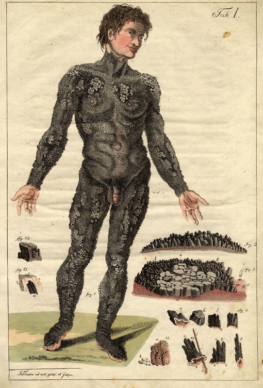 ... und der Stachelschweinmann aus "The Porcupine-Man", 1802