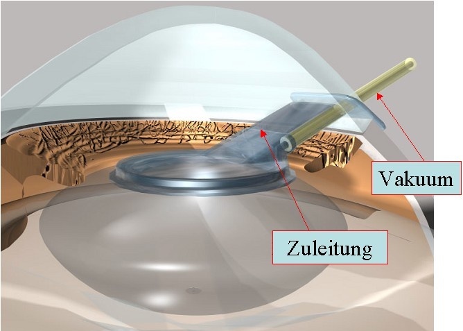 Mit einem winzigen Deckel wird die eröffnete Augenlinse per Vakuum abgedichtet. / Abbildung: Universitäts-Augenklinik Heidelberg.