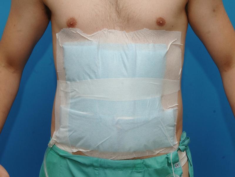 Studienpatient nach Bauch-OP an der Chirurgischen Universitätsklinik Heidelberg. Damit der Patient nicht erkennt, ob sein Operationsschnitt längs oder quer  angelegt wurde, musste der Verband den ganzen Bauchraum abdecken.