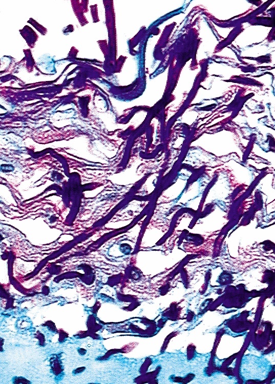 Infektion rekonstituierter Haut mit einem klinischen Isolat von Candida albicans. Der Pilz zerstört die schützende Keratinozyten-Schicht und dringt nach 48 Stunden in der Hyphenform in das Hautmodell ein und zerstört es.