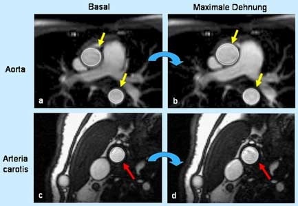 Mit der hoch aufgelösten Magnetresonanz-Bildgebung lässt sich die Elastizität der Aorta (gelbe Pfeile) und der Halsschlagader (roter Pfeil) detailliert darstellen. Bei jungen Rauchern sind diese Arterien weniger elastisch. Aufnahmen: Wiesmann