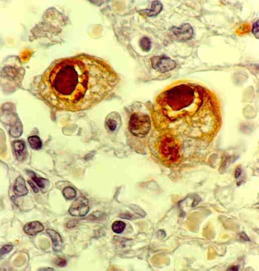 Durch die Cytomegalovirus-Infektion veränderte Zellen (sogenannte Eulenaugenzellen) im Gewebsverband.