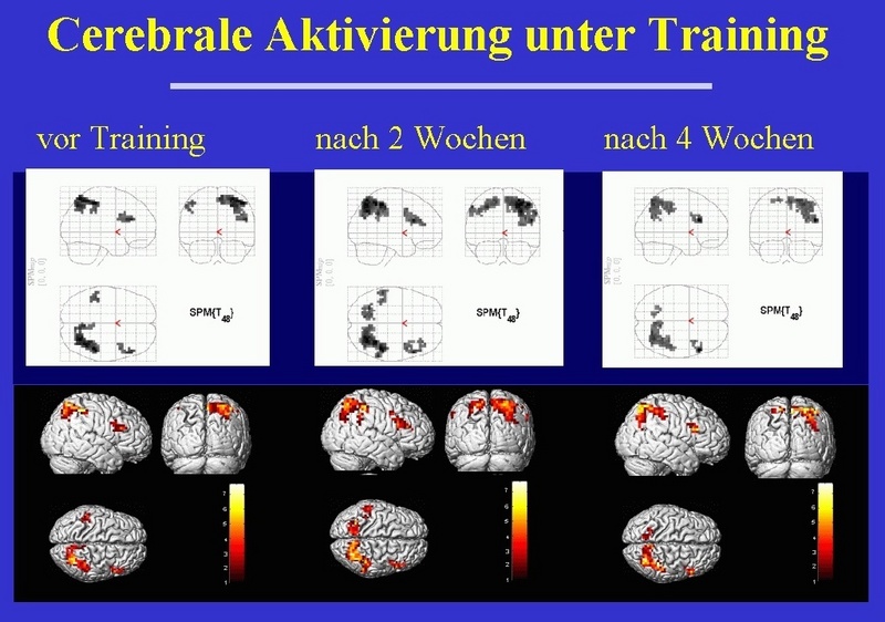 Die Aktivierung vor dem Gedächtnis-Training, nach 2 und nach 4 Wochen in der funktionellen Magnetresonanz-Tomographie. / Abbildung: Psychiatrische Universitätsklinik, Sektion Gerontopsychiatrie.