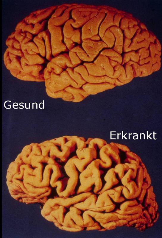 Hirnatrophie bei erkrankten Personen.
